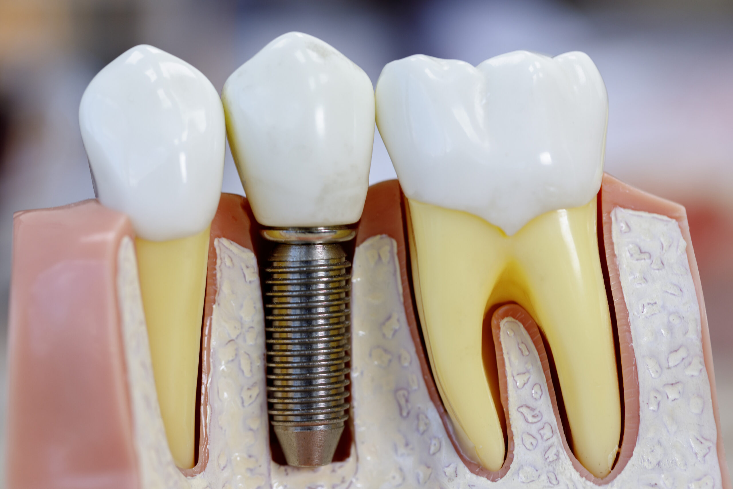 Close up of dental model with implantation Single dental implants consist of three parts: a metal post replaces the root, an abutment attaches a crown, and the crown.