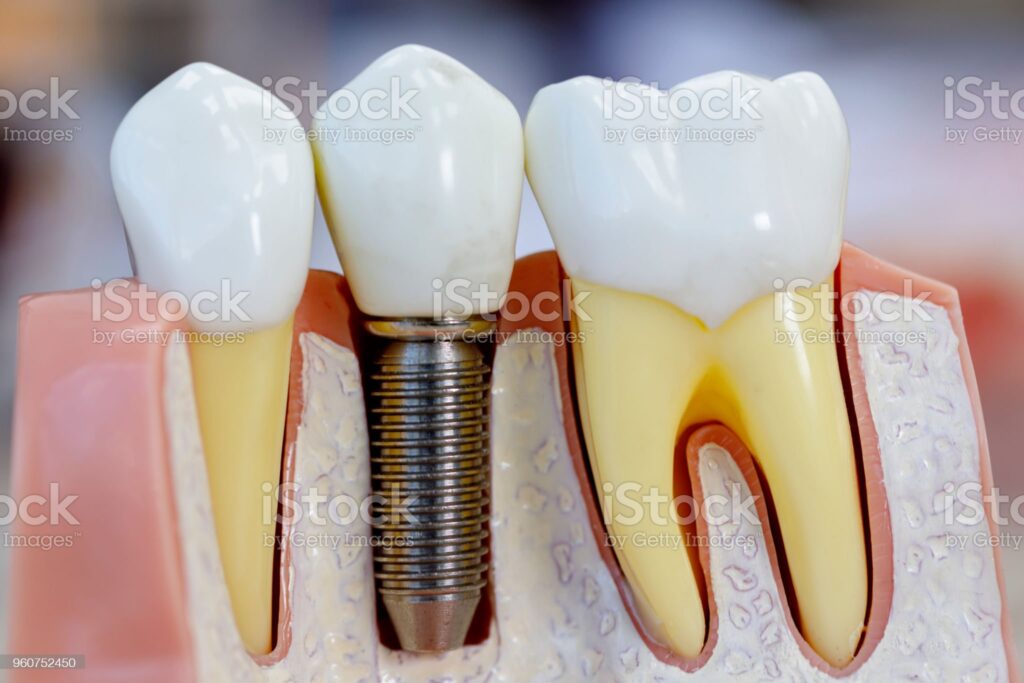 Single dental implants consist of three parts: a metal post replaces the root, an abutment attaches a crown, and the crown.