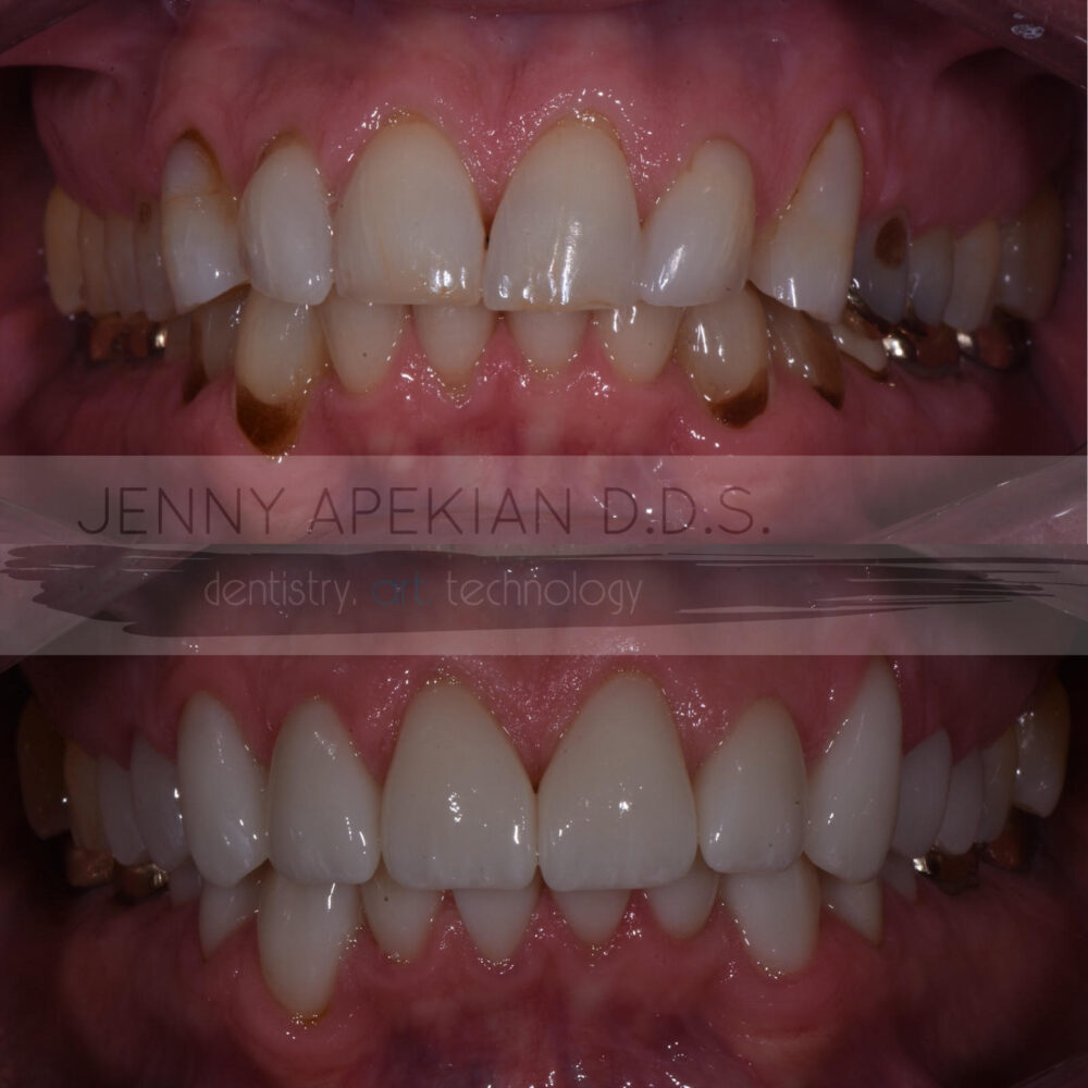 Cerec Crown Before & After