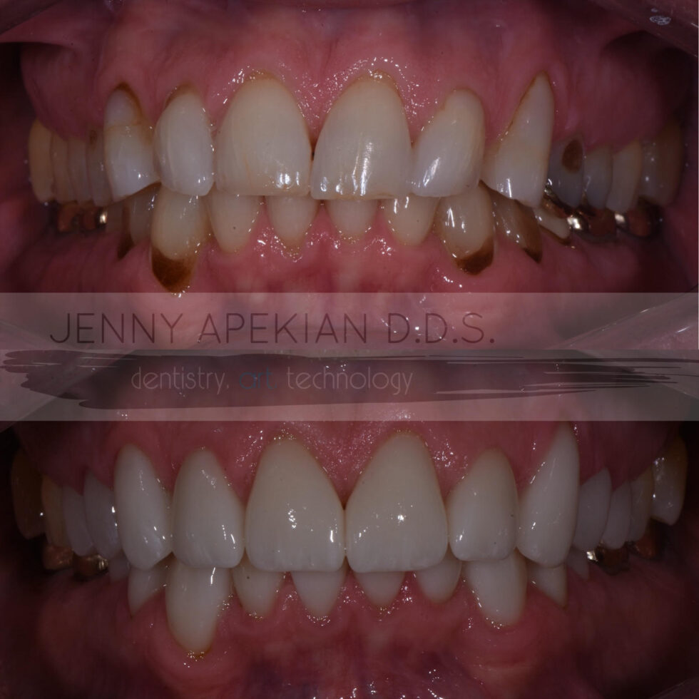 Implant & Cosmetic Dentistry Before & After Photos Midtown Dental