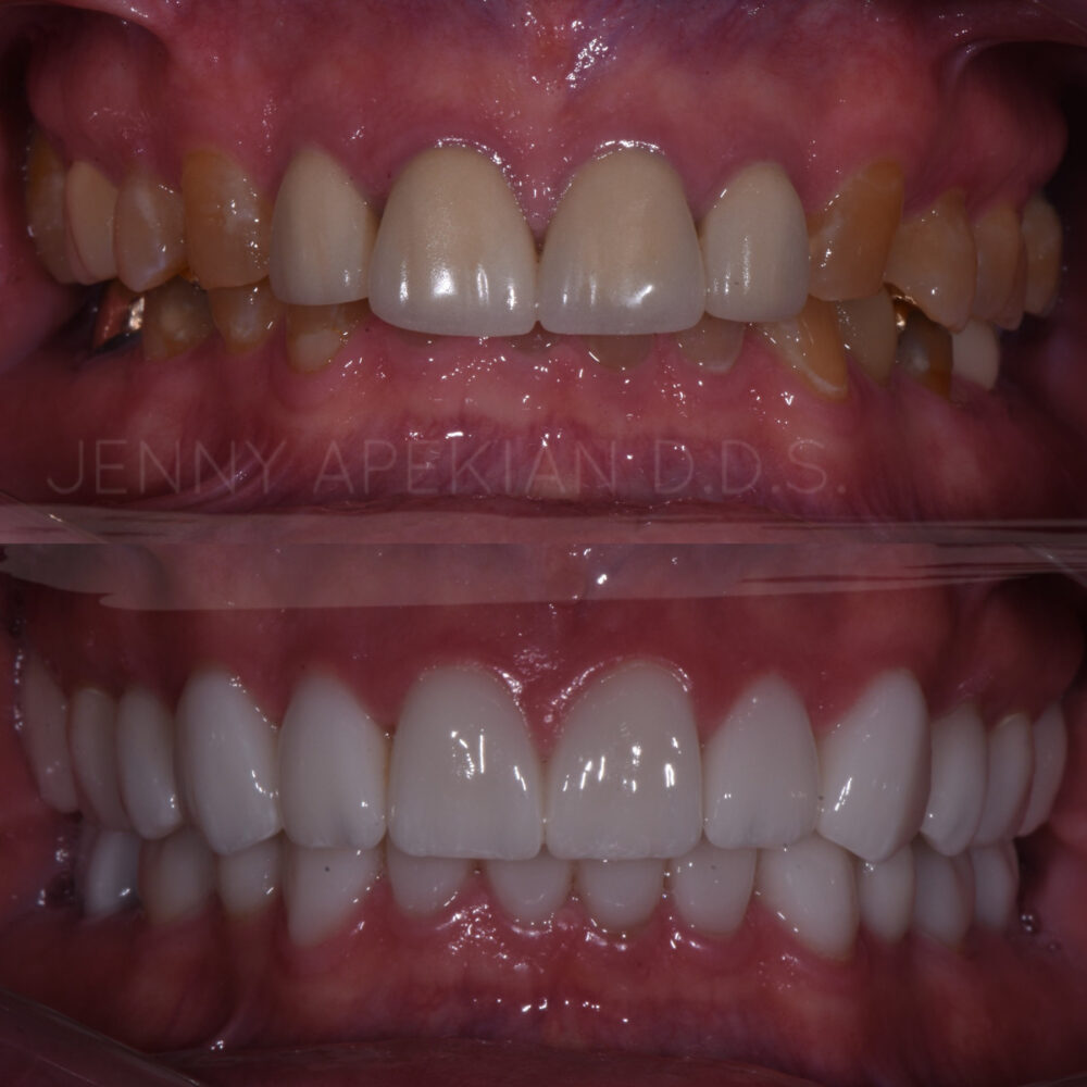 Full Mouth Rehab Before & After