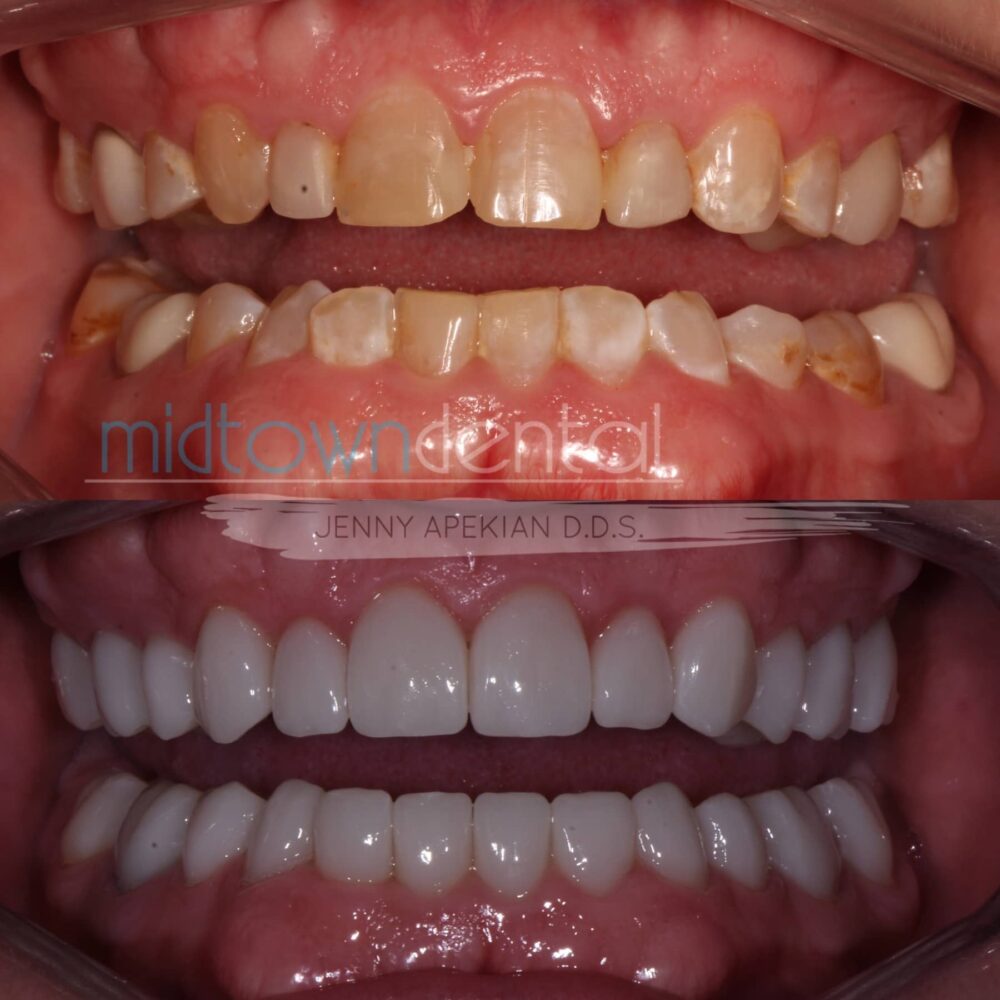 Full Mouth Rehabilitation Before & After