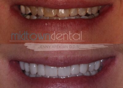 Full mouth rehabilitation before and after photo