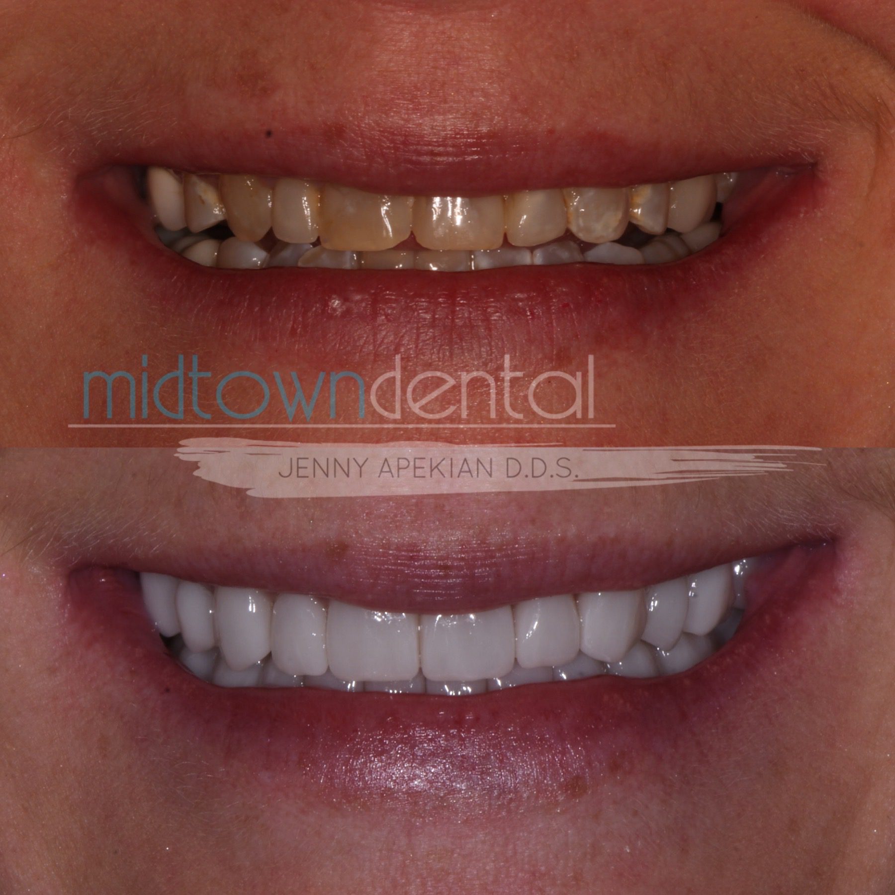 Full Mouth Rehabilitation Before & After Photos Midtown Dental