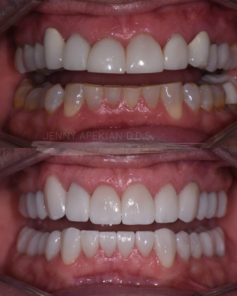Full mouth rehabilitation close up before and after photo