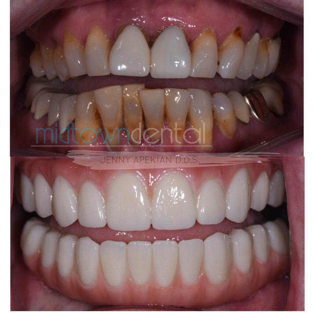 Teeth In a Day Full Mouth Rehabilitation Before & After