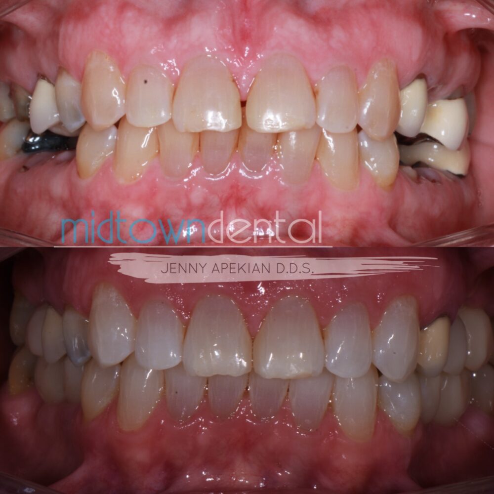 Multiple Missing Teeth Before and After