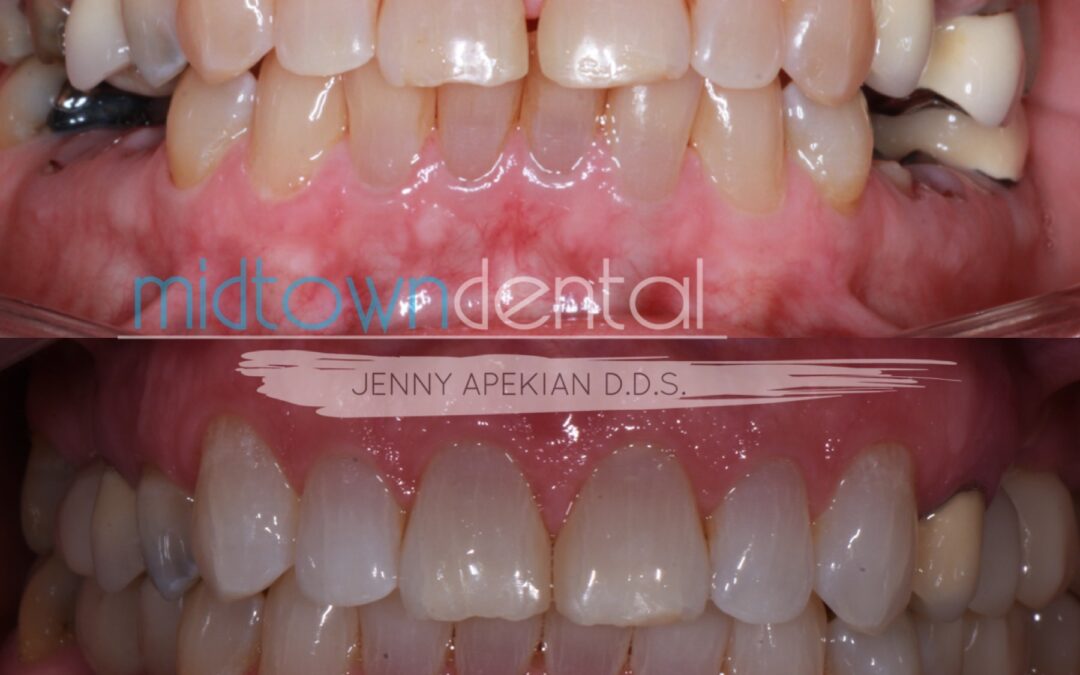 6Implants Archives Midtown Dental