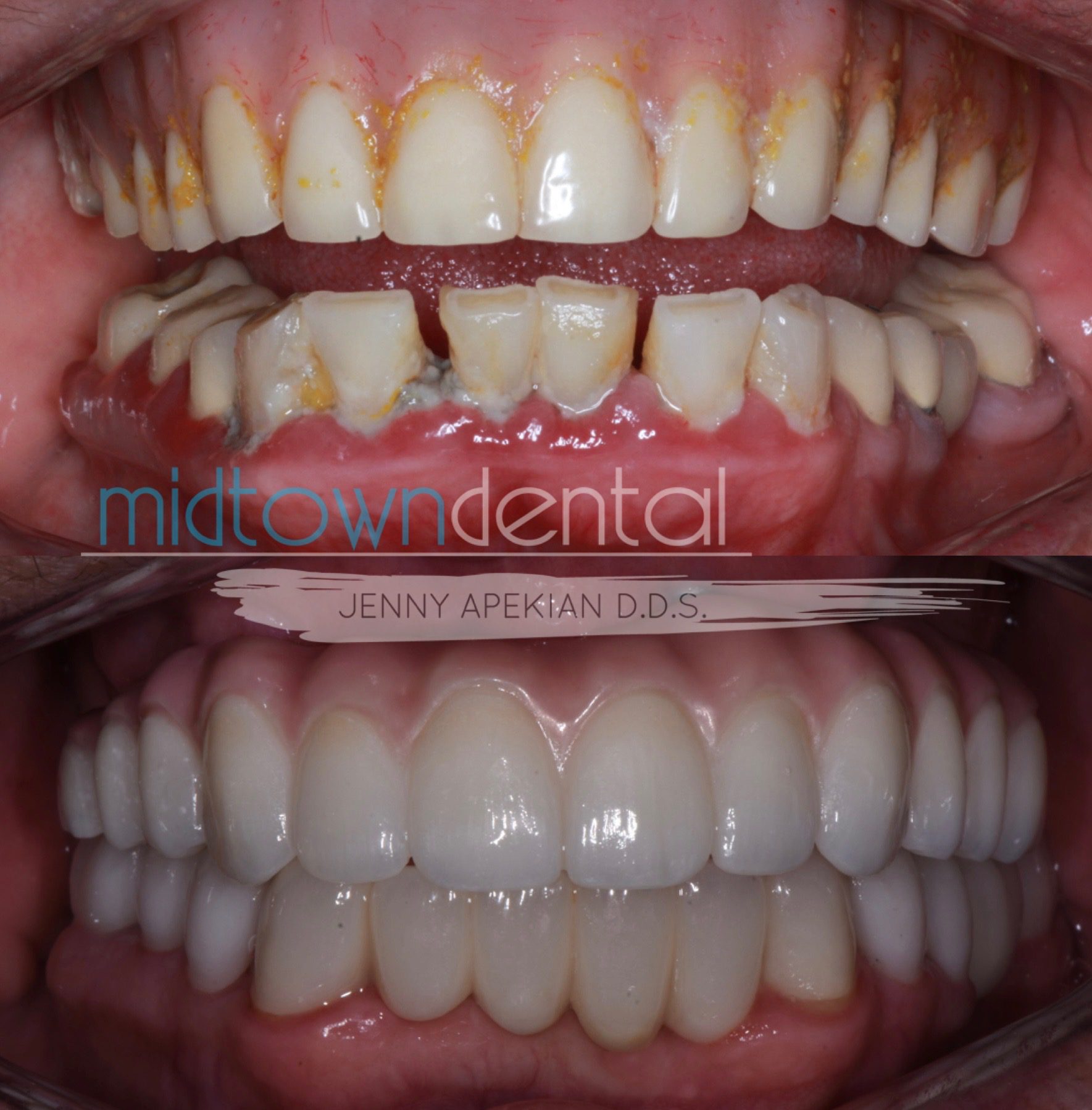 Implants after Periodontal Therapy Before & After
