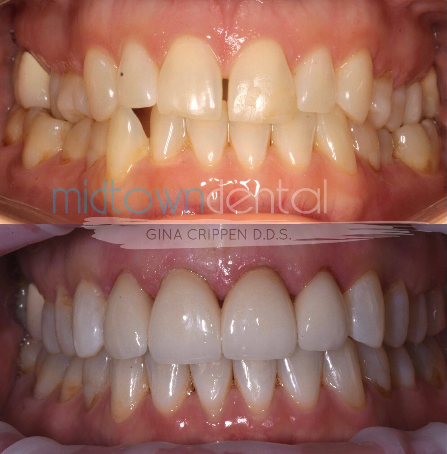 Invisalign Case with Crowns Before & After