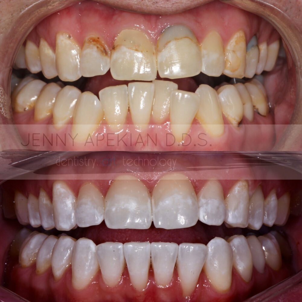 Invisalign Treatment with Whitening Before & After