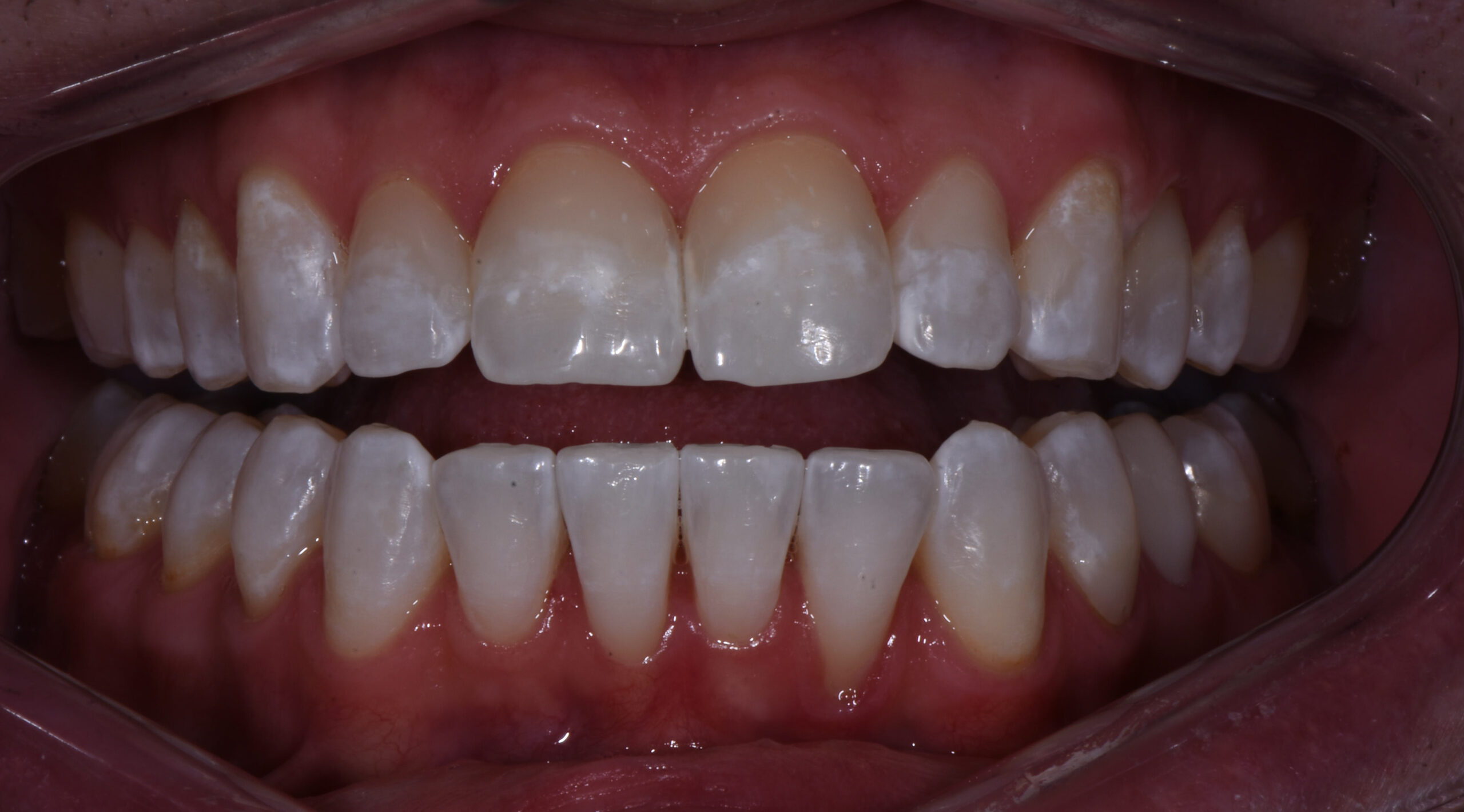 Invisalign Treatment Before & After Midtown Dental Sacramento, CA