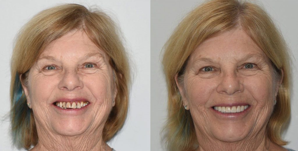 Before and after of a 75-year-old female patient who presented to the office seeking quite extensive restorative and cosmetic treatment.