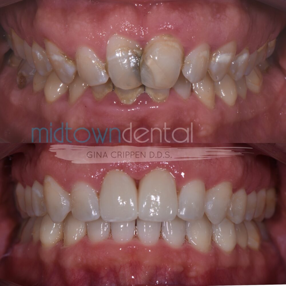 Invisalign with Veneers Before & After