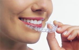 Teeth Invisalign