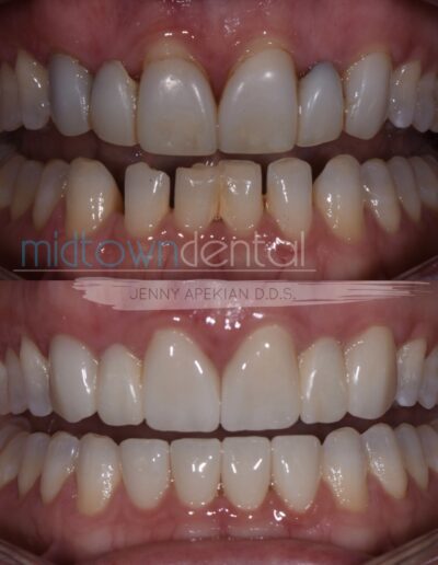 Close up before and after of a bridge and cerec crown case that also involved invisalign
