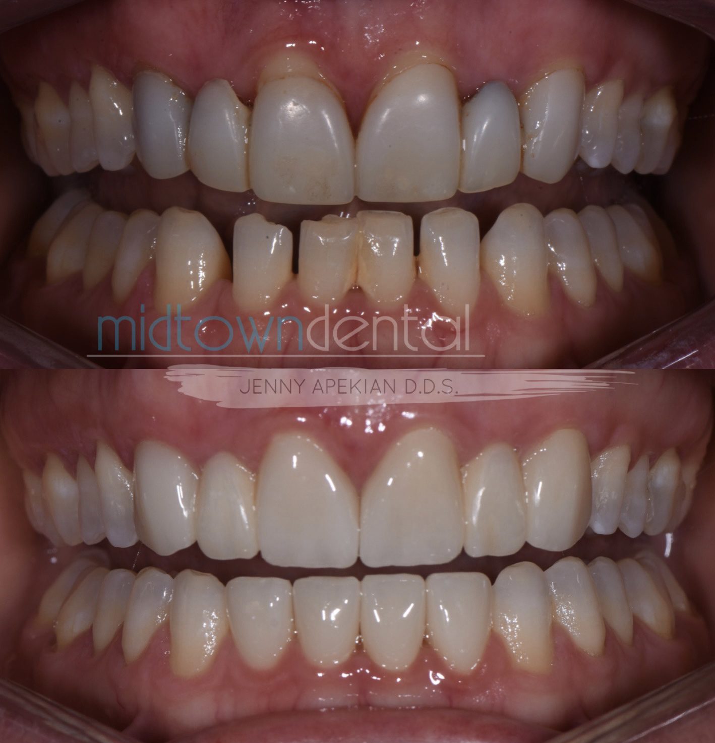 Dental Bridges & Crowns Before & After