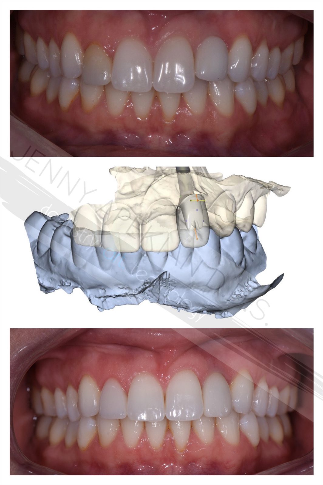 Implant & Cosmetic Dentistry Before & After Photos Midtown Dental