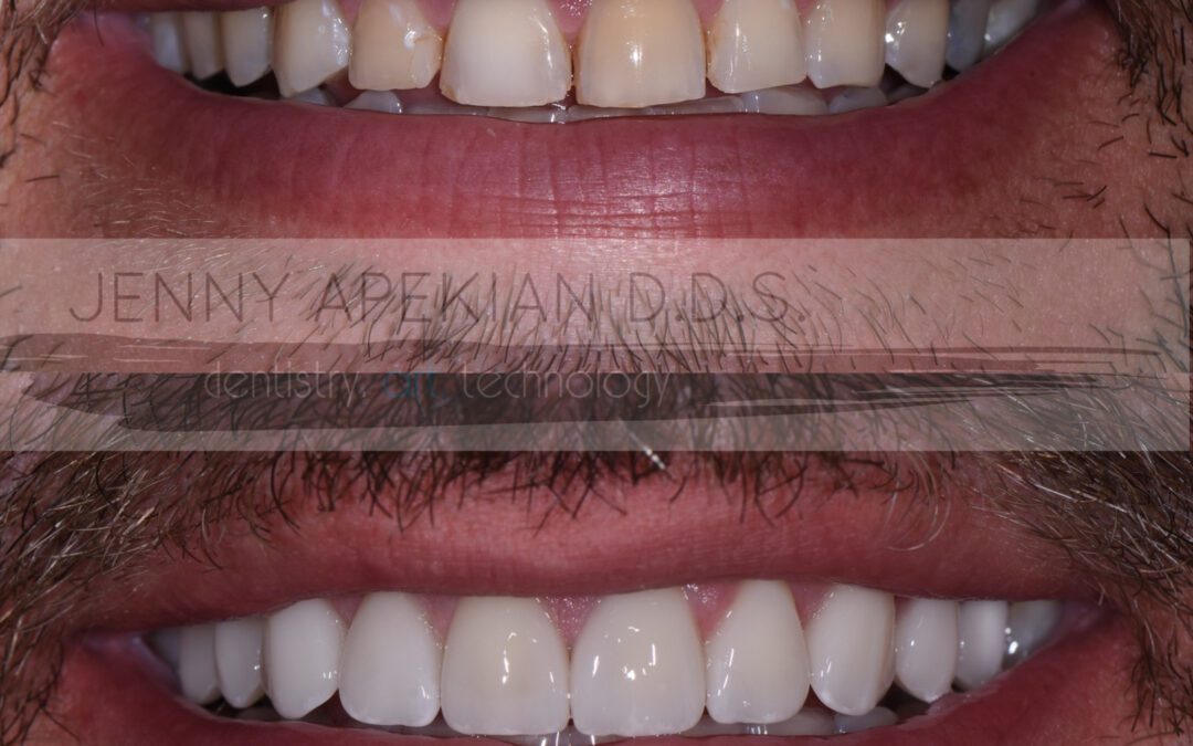 3Veneers Archives Midtown Dental