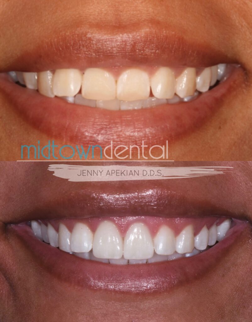 Cerec Veneers Before & After Midtown Dental Sacramento, CA