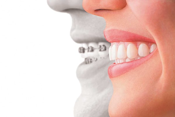 Invisalign Clear Aligner vs Metal Braces Image by Midtown Dental of Sacramento, CA.