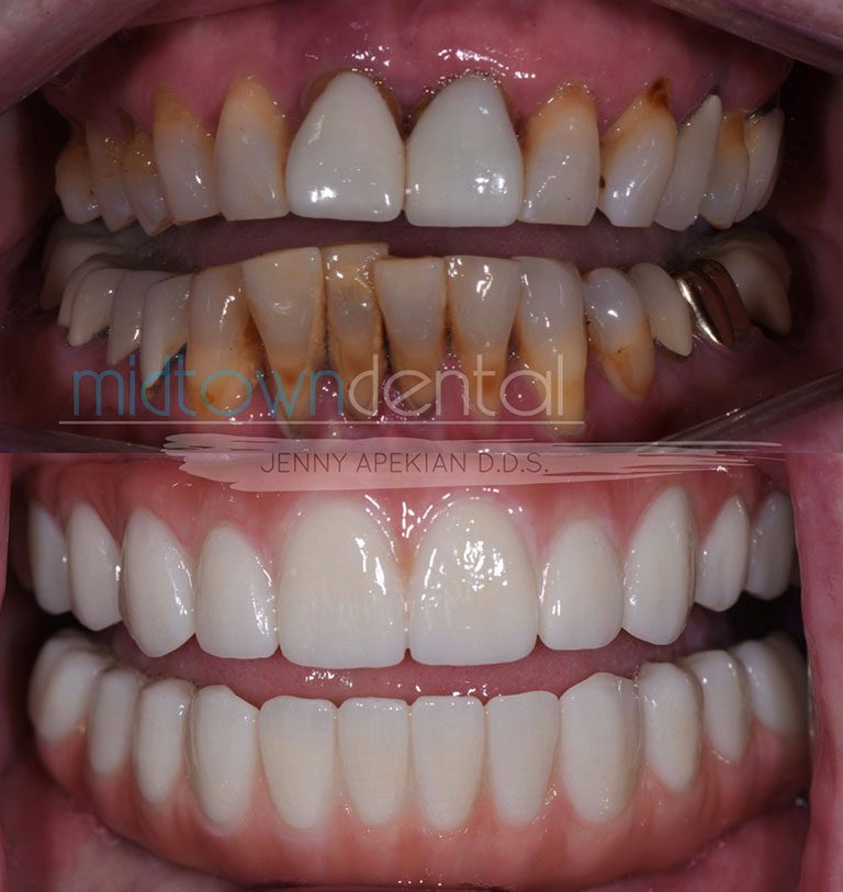 A before and after photo of how fixed hybrid dentures/full arch/all-on-4 changed a Midtown Dental patient's smile.