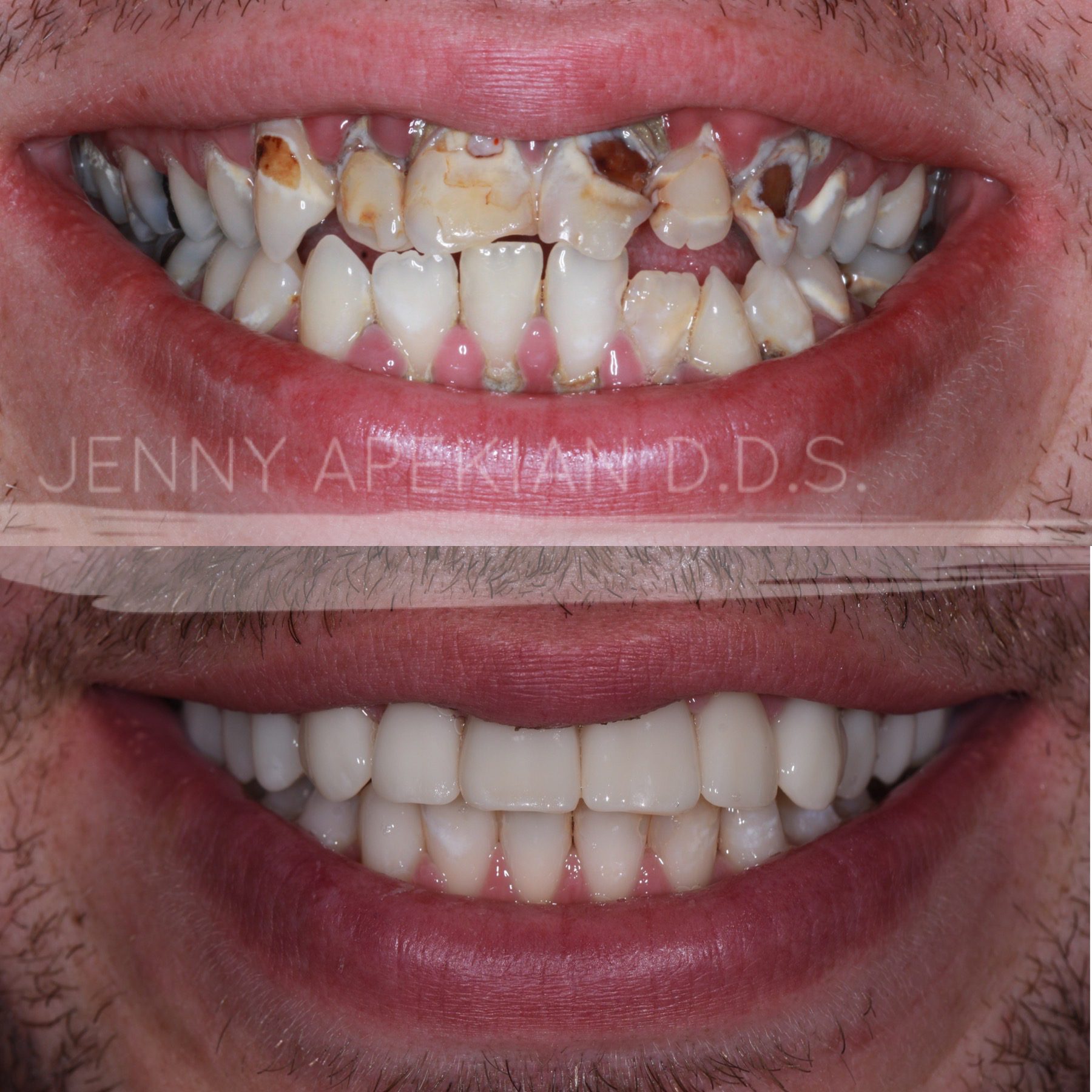 Full mouth rehabilitation close up before and after photo