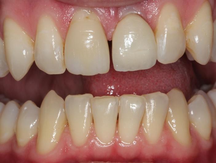 Tooth before CEREC crown