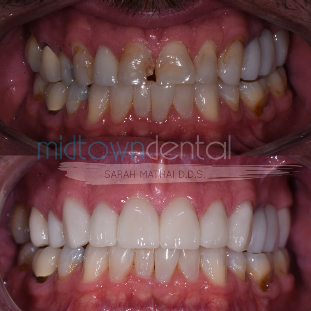 cerec crowns before and after teeth close up
