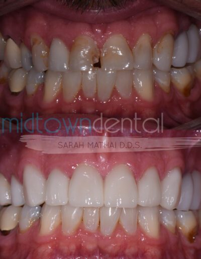 cerec crowns before and after teeth close up