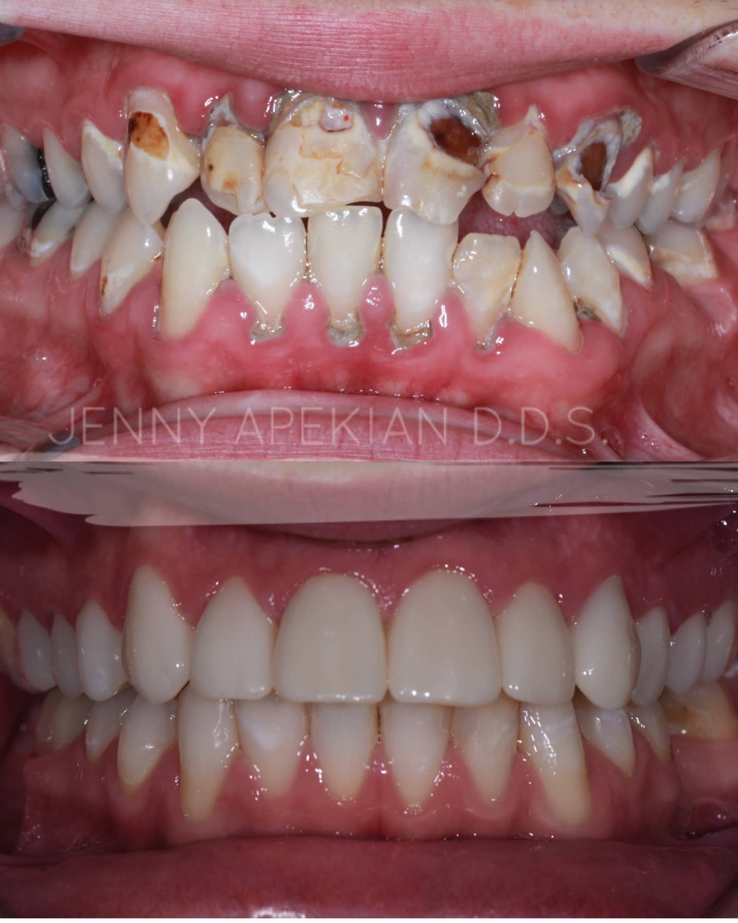 Ortho Cerec Crown Before & After