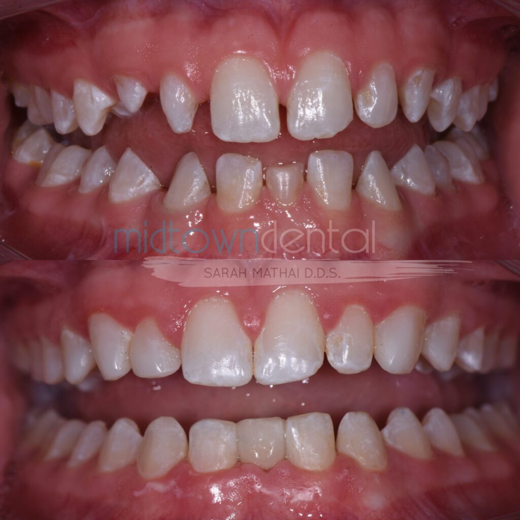 cosmetic bonding plus cerec bridges before and after teeth closeup for a midtown dental patient