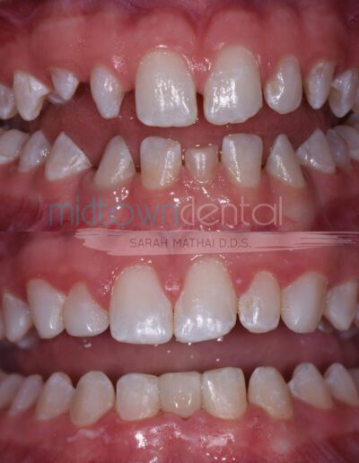 cosmetic bonding plus cerec bridges before and after teeth closeup for a midtown dental patient