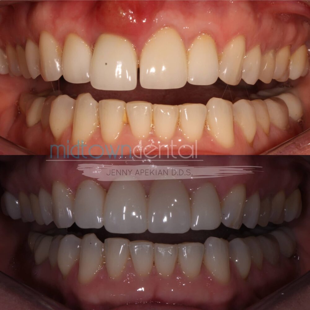 Upper Bridge After Extraction Before & After