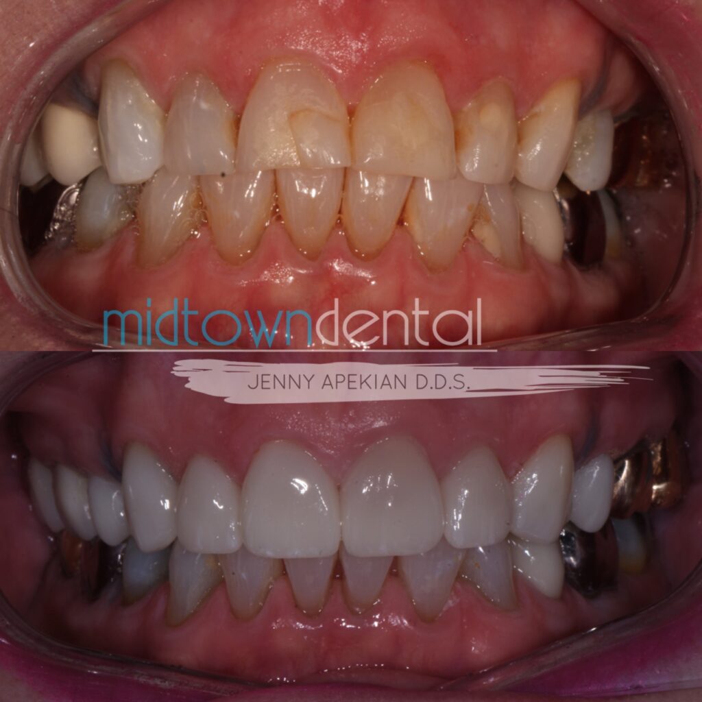Dental Crowns Before and After Photos