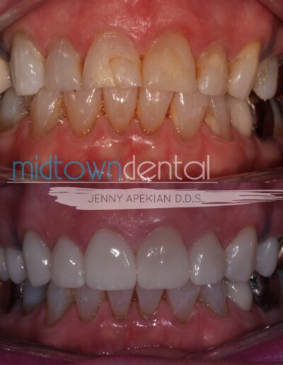 Retracted view of a before and after dental crowns case
