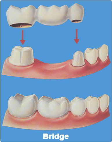 Porcelain Crown Placement Porcelain Crown Placement