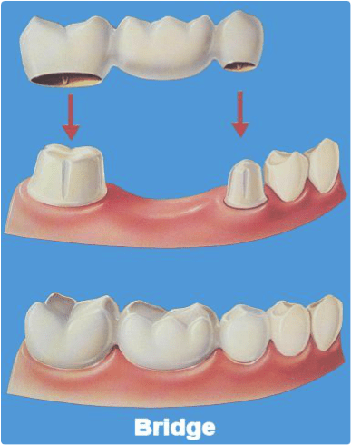 placing a dental bridge with porcelain crowns