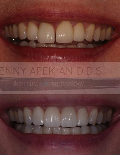 Stacked before and after photo for dental bridges