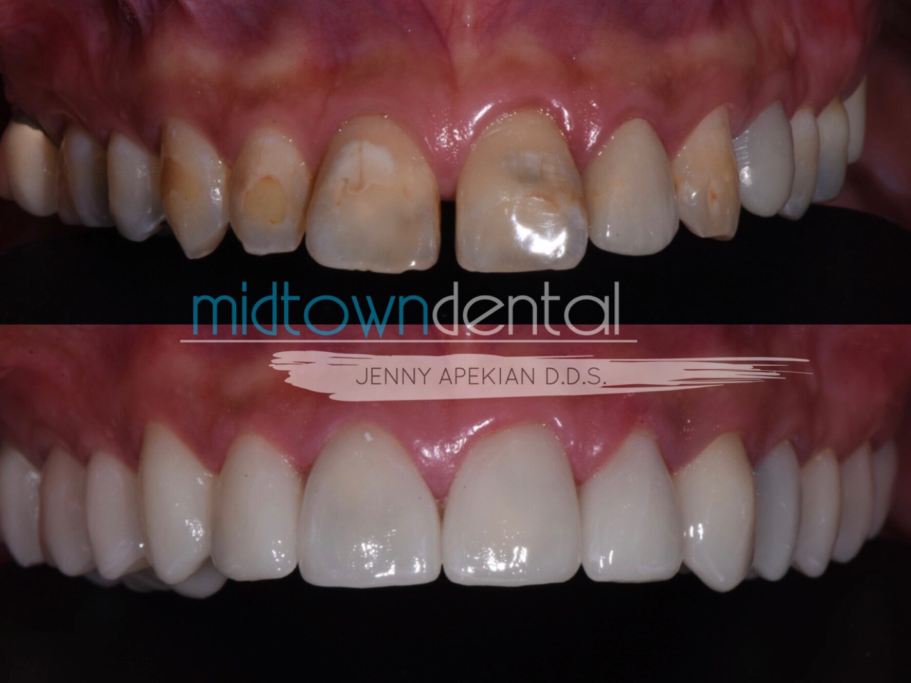Same Day Upper Teeth Rehab Before & After