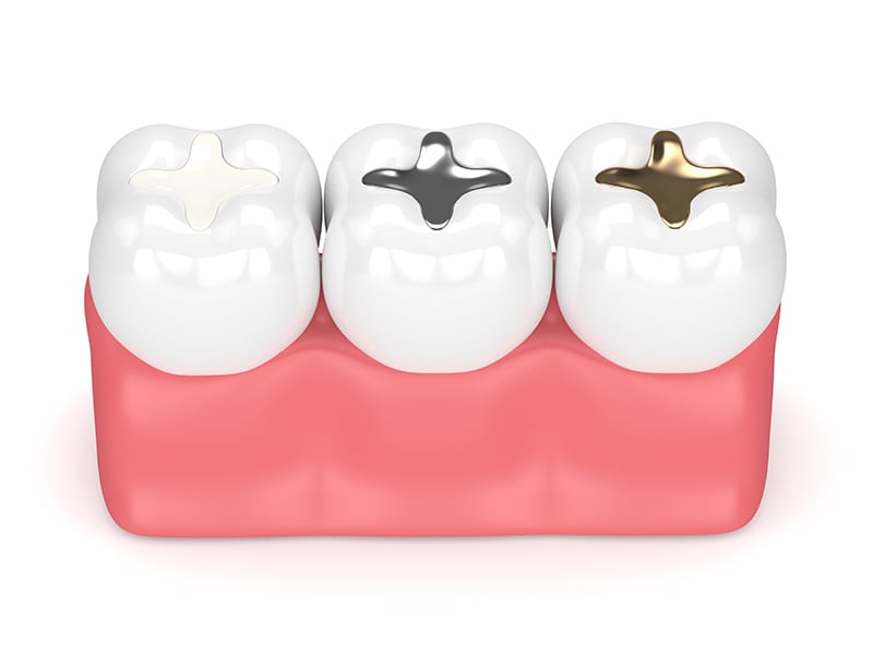 image of 3 types of dental filling materials, Composite Fillings, Amalgam Fillings, Precious Metal Fillings