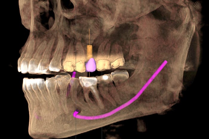 Dental Implants