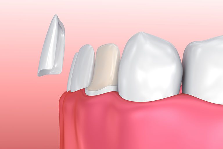 A computer-generated graphic illustrates how a dentist at Midtown Dental fits a porcelain dental veneer to an existing tooth.