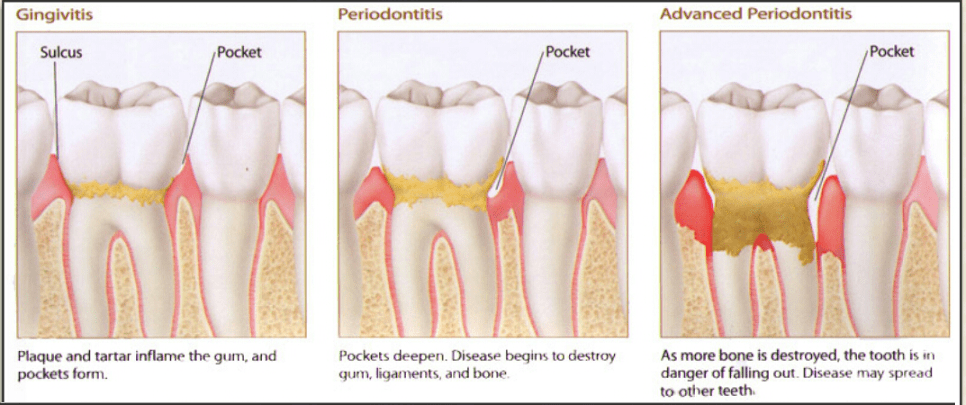 Stages of Gum Disease: Gingivitis, Periodontitis, Advanced Periodontitis