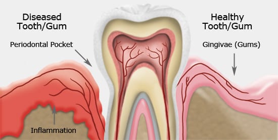 Gum Disease Treatment in Sacramento, CA