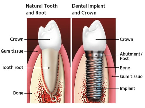 Implant