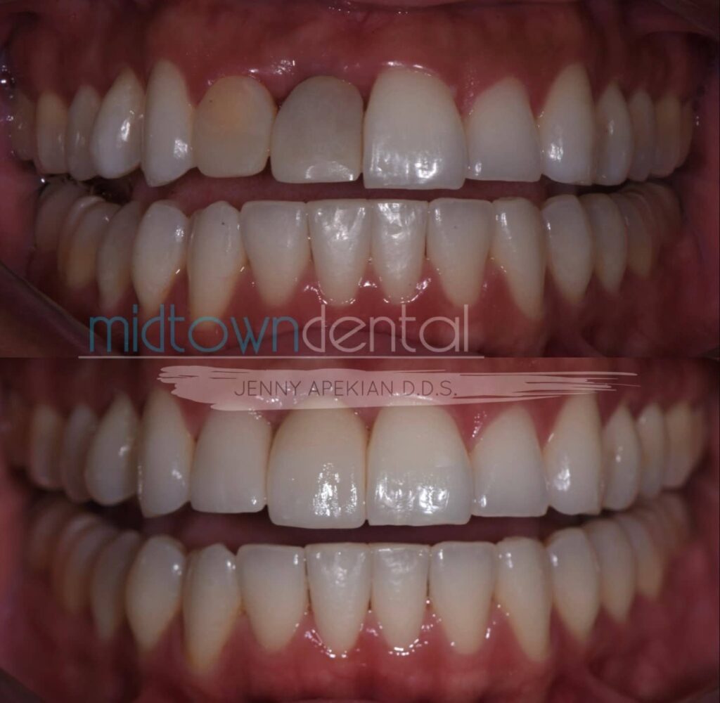Retracted view of teeth replaced with implants before and after photo