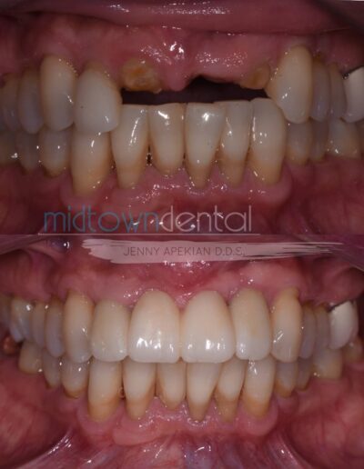 Retracted view of missing front teeth replaced with implants before and after photo