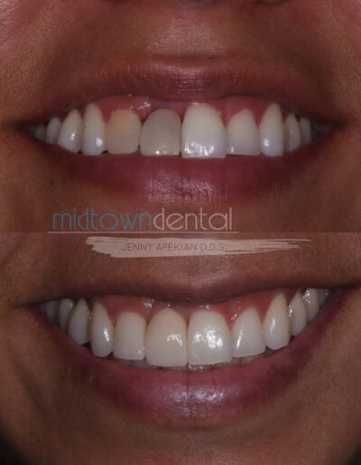Smile view of teeth replaced with implants before and after photo