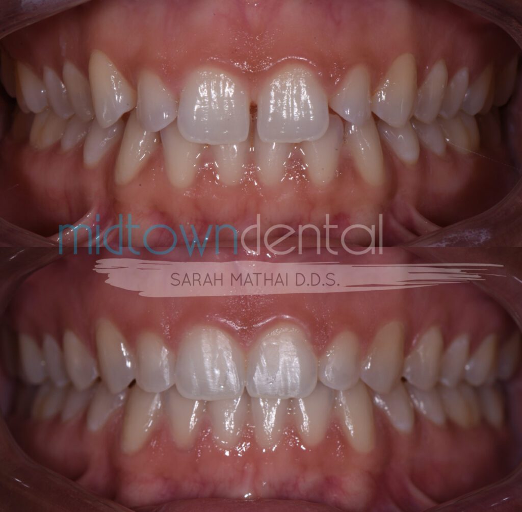 Invisalign treatment before and after photo of a Midtown Dental patient
